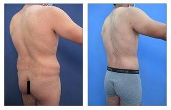 Male Brazilian Butt Lift