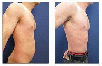 Male Breast Surgery Cost