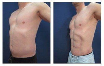 Tummy tuck, Liposuction before and after.