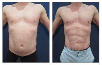 Tummy tuck and liposuction before and after.
