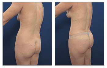 Experience the transformative results of a mommy makeover, specifically designed to address skin redundancy. See incredible before and after images of tummy tuck procedures.