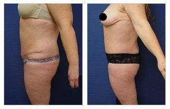 Medial thigh tuck for plus sized clients