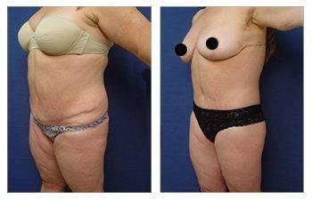 Medial thigh tuck for plus sized clients