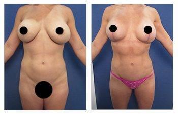 Mini Tummy Tuck Recovery