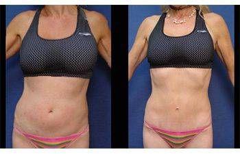 Mini tummy tuck before and after showcasing results on a fit girl.