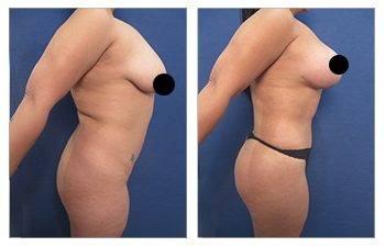 VASER High Definition Liposuction tummy tuck before and after.