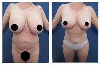 A woman's breast undergoing surgery for skin redundancy, resulting in a before and after transformation.