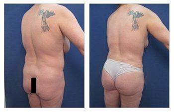 A woman's breast before and after undergoing a breast lift, to round out their shape.