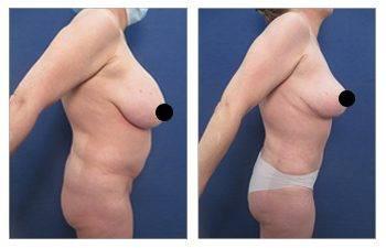 Experience the transformative results of a mommy makeover, specifically designed to address skin redundancy. See incredible before and after images of tummy tuck procedures.