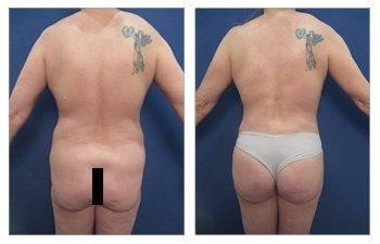 Before and after pictures of a woman with a large breast who underwent Liposuction.