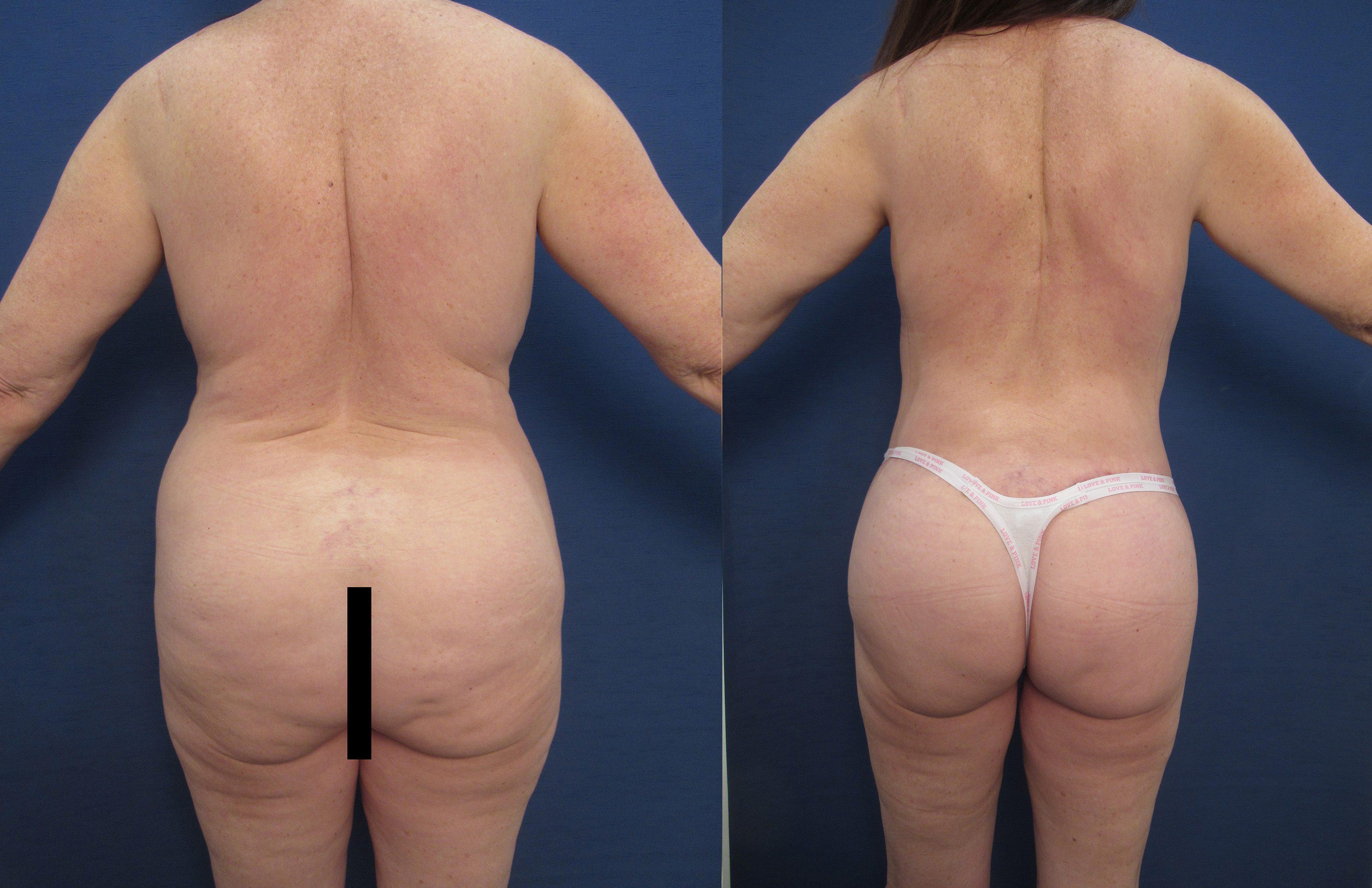 Achieve a flawless transformation with our tummy tuck procedure, eliminating the need to worry about dog ears in your before and after photos.