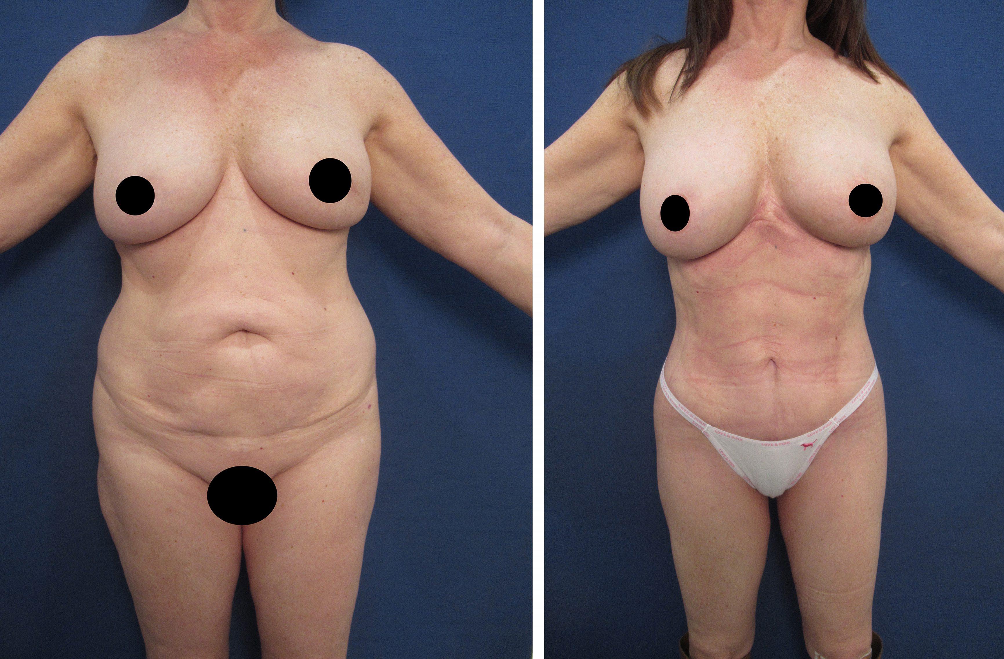 A woman's breast before and after surgery for breast herniation.