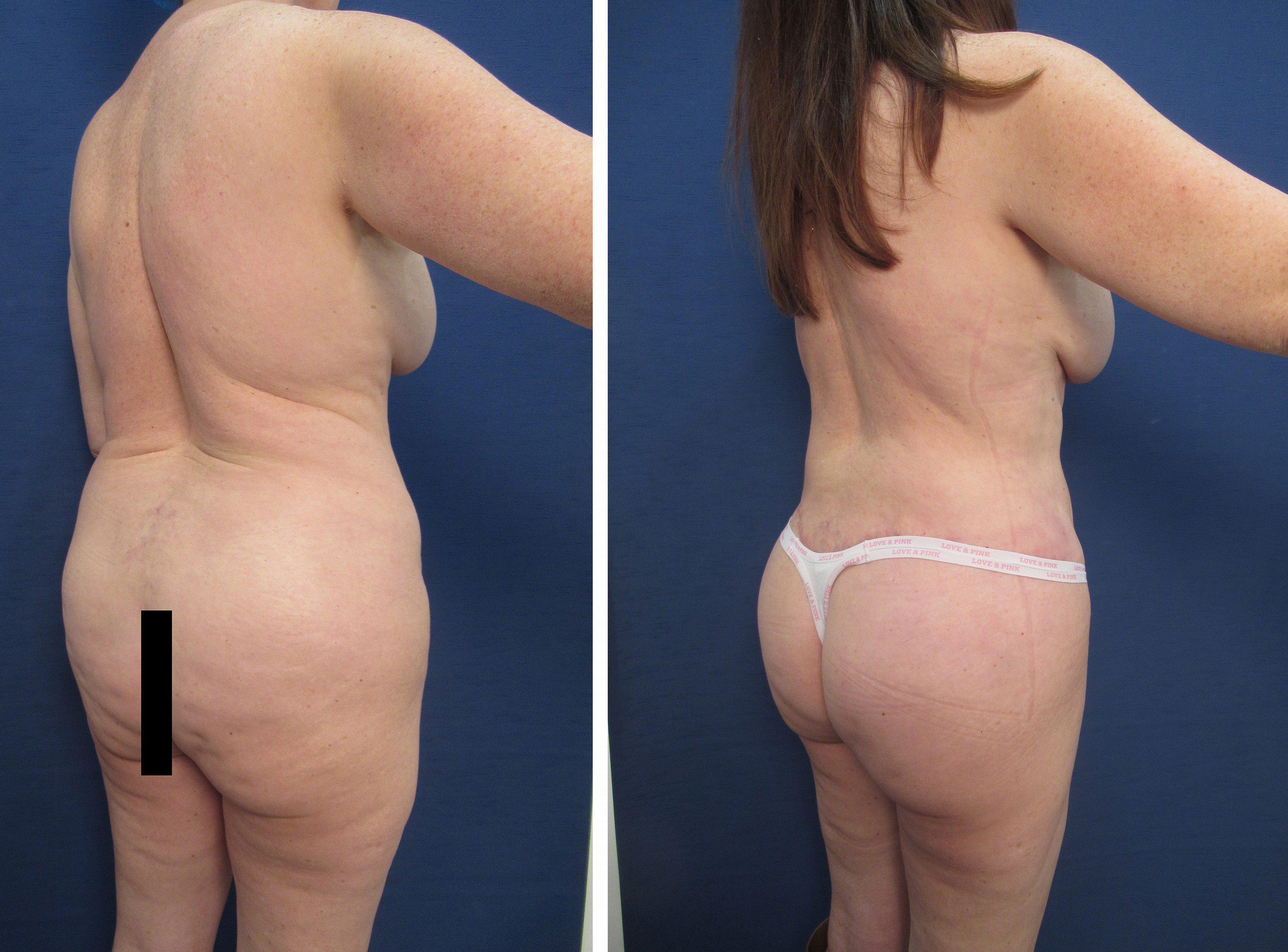 Achieve a remarkable transformation with a tummy tuck before and after, while avoiding dog ears.