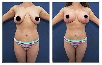 A woman's breasts before and after undergoing a Mommy Makeover surgery to achieve improved proportions.