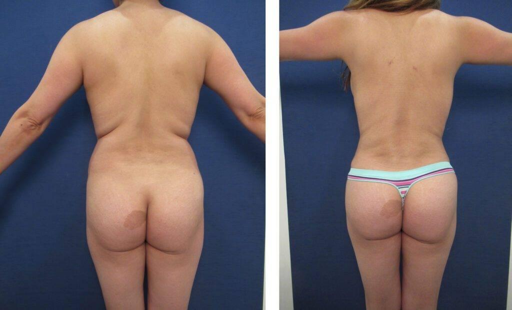 Experience the transformative results of a mommy makeover, specifically designed to address skin redundancy. See incredible before and after images of tummy tuck procedures.
