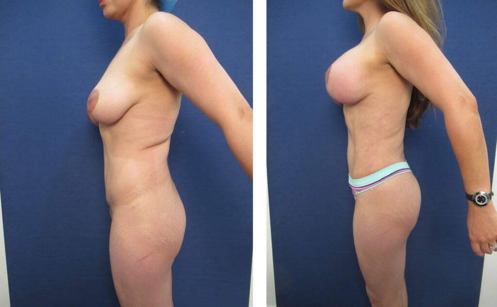Learn the secrets to fixing the lower abdominal bulge with tummy tuck before and after transformations.