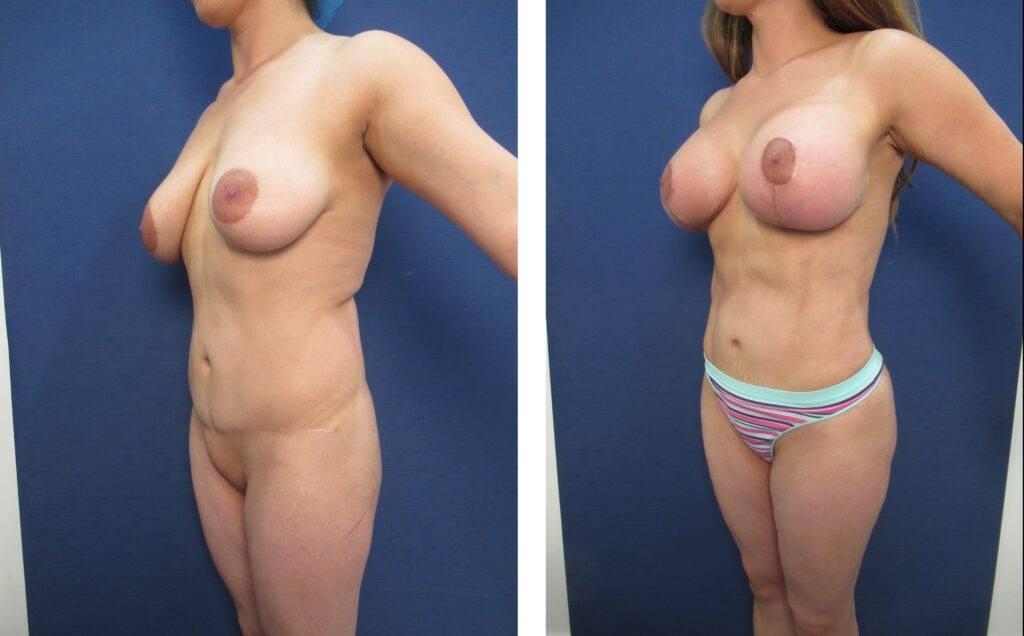 A woman's breasts before and after breast surgery as part of a Mommy Makeover to create improved proportions.