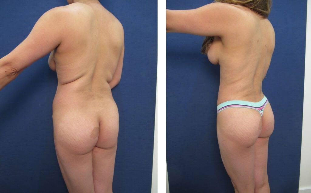 Witness the transformative effects of a woman's tummy tuck procedure through captivating before and after photos, showcasing the remarkable results of a mini tummy tuck. Experie…