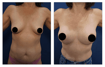 A woman's breast before and after **Breast Augmentation** surgery.