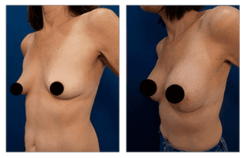 A woman's breasts before and after breast augmentation with HD Liposuction.
