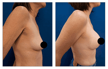 A woman's breast before and after breast augmentation surgery.