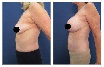 High definition abdominal contouring, showcasing tummy tuck before and after results.