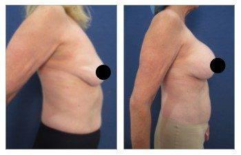 Learn about the transformative results of a tummy tuck before and after experiencing the cutting-edge VASER technology that effectively melts fat cells.