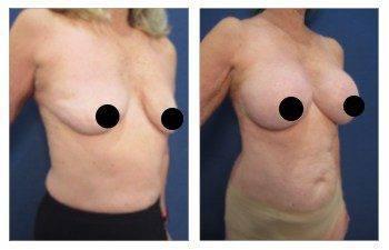 Before and after breast surgery, showcasing the effects of saline implants.