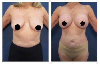 Before and after pictures of a woman with a large breast who underwent Liposuction.