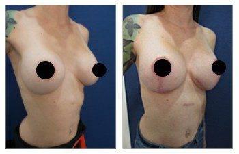 A woman's breast before and after surgery, including tips on how to fix poor areola scarring after a breast lift.