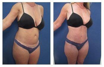 tummy tuck results