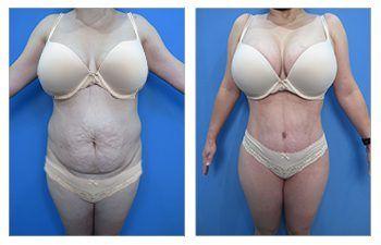 How To Avoid Skin Redundancy during High Definition Body Contouring Surgery
