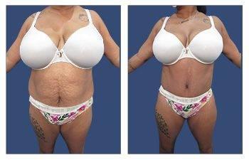 High Definition Body Contouring for the Plus-size Patient
