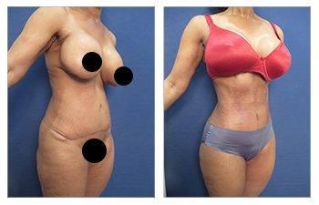 Renuvion J Plasma - "Shrink Wrap" Loose Skin Permanently
