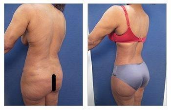 Renuvion J Plasma - "Shrink Wrap" Loose Skin Permanently