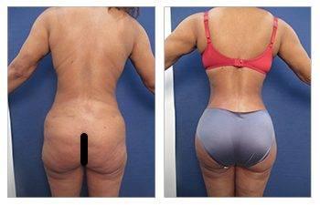 Renuvion J Plasma - "Shrink Wrap" Loose Skin Permanently