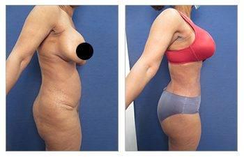 Renuvion J Plasma - "Shrink Wrap" Loose Skin Permanently