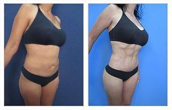 VASER Liposuction tummy tuck before and after.