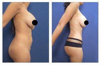 Body Contouring Procedure