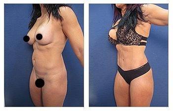 Renuvion Skin Contraction