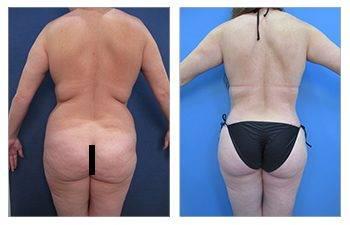 Tummy tuck before and after with Safe BBL Protocol.