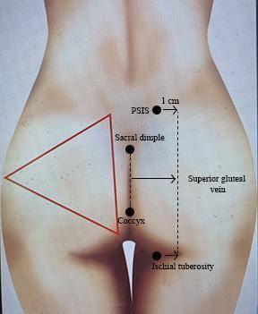 A diagram of a woman's body following Safe BBL Protocol.