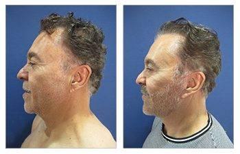 Transforming a woman's breasts through surgery, achieving the best female abdominal contouring.