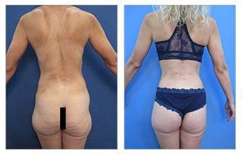 Skinny BBL Surgeons — patient photo