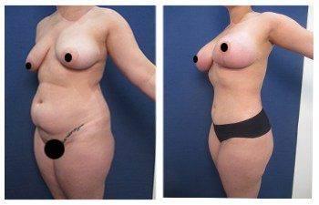 Tips For Fast Recovery After VASER Liposuction