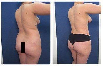 High definition liposuction Beverly Hills