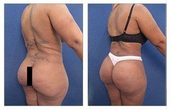 A woman's lateral hip fullness before and after plastic surgery.