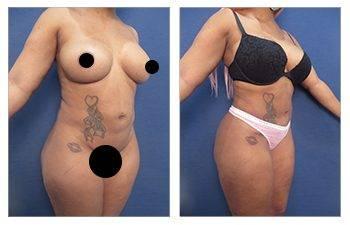 Before and after pictures showcasing a woman's breast surgery with an emphasis on lateral hip fullness.