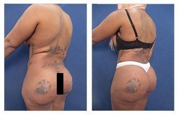 A woman's lateral hip fullness before and after tummy tuck.