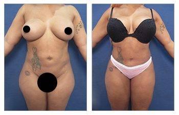 Tummy tuck for lateral hip fullness before and after.